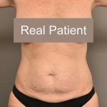Tummy Tuck Before & After Patient #296