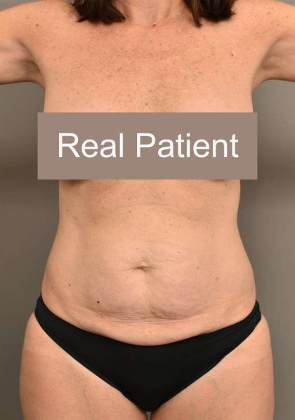 Tummy Tuck Before & After Patient #296