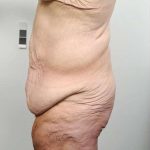 Lower Body Lift Before & After Patient #985