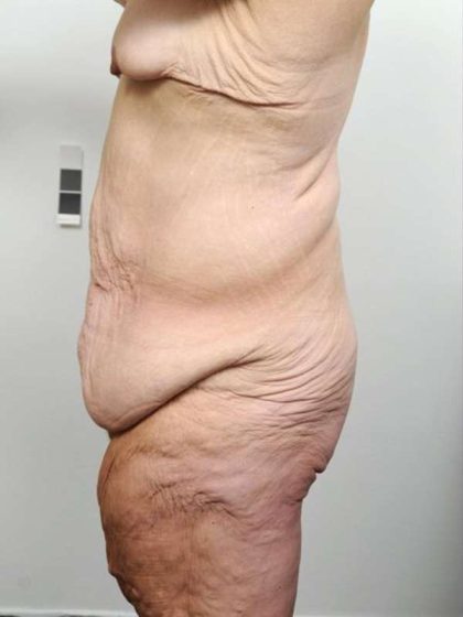Lower Body Lift Before & After Patient #985