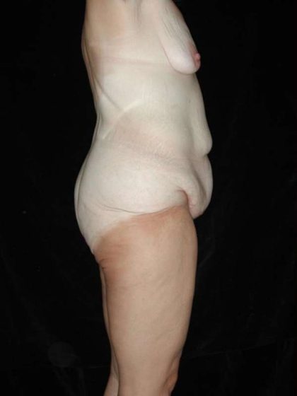 Lower Body Lift Before & After Patient #999