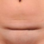 Scar Revision Before & After Patient #1071
