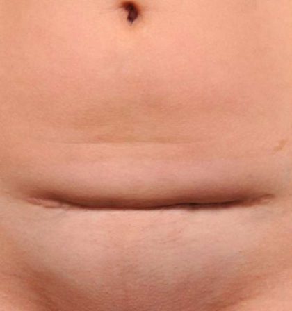 Scar Revision Before & After Patient #1071