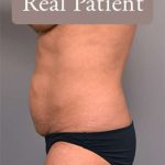 Tummy Tuck Before & After Patient #303