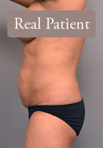 Tummy Tuck Before & After Patient #303