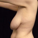 Breast Lift Before & After Patient #1257