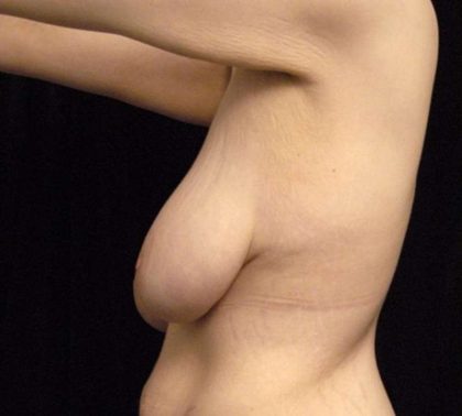 Breast Lift Before & After Patient #1257