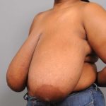 Breast Reduction Before & After Patient #1293