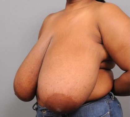 Breast Reduction Before & After Patient #1293