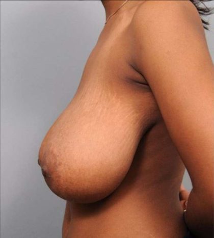 Breast Reduction Before & After Patient #1332