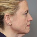 Facelift Before & After Patient #1371