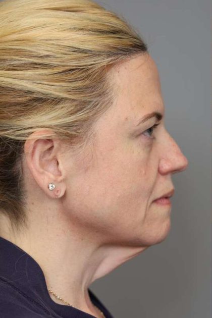 Facelift Before & After Patient #1371