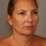 Facelift Before & After Patient #1380