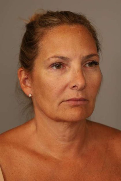 Facelift Before & After Patient #1380