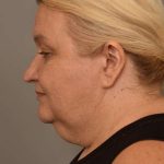 Facelift Before & After Patient #1389