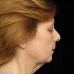 Facelift Before & After Patient #1411