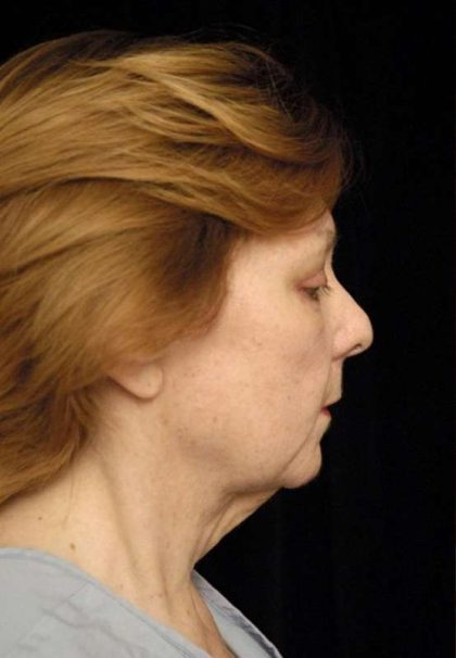 Facelift Before & After Patient #1411