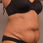 Tummy Tuck Before & After Patient #312