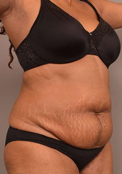 Tummy Tuck Before & After Patient #312