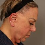 Facelift Before & After Patient #1418