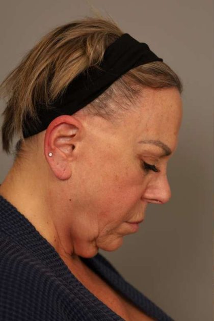 Facelift Before & After Patient #1418