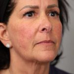 Facelift Before & After Patient #1427