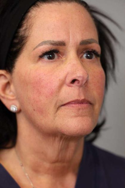 Facelift Before & After Patient #1427