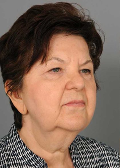 Facelift Before & After Patient #1436