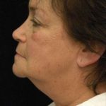Facelift Before & After Patient #1443