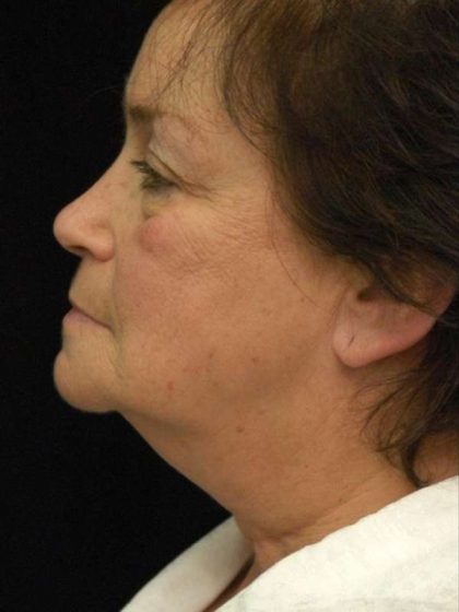 Facelift Before & After Patient #1443
