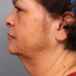 Naturalift&trade; Mini Facelift Before & After Patient #1452