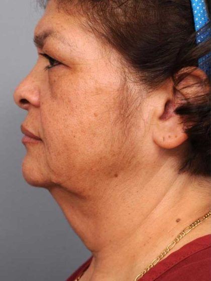 Naturalift™ Mini Facelift Before & After Patient #1452