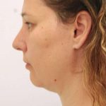 Naturalift&trade; Mini Facelift Before & After Patient #1464