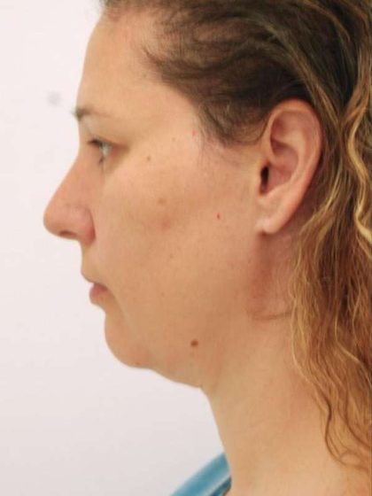 Naturalift™ Mini Facelift Before & After Patient #1464