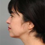 Naturalift&trade; Mini Facelift Before & After Patient #1474