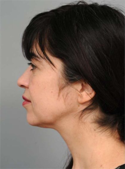 Naturalift™ Mini Facelift Before & After Patient #1474