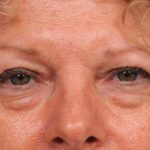 Eyelid Surgery Before & After Patient #1481