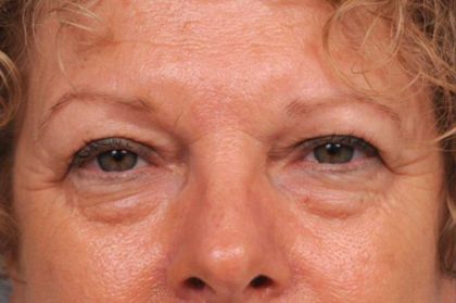 Eyelid Surgery Before & After Patient #1481