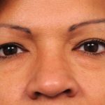 Eyelid Surgery Before & After Patient #1490