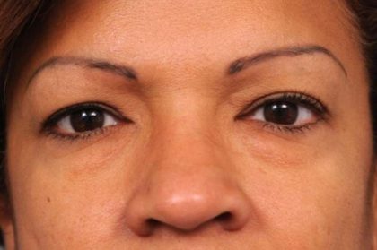 Eyelid Surgery Before & After Patient #1490