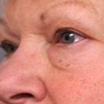 Eyelid Surgery Before & After Patient #1504