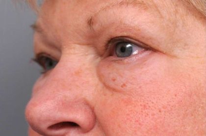 Eyelid Surgery Before & After Patient #1504