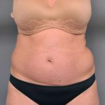 Tummy Tuck Before & After Patient #319