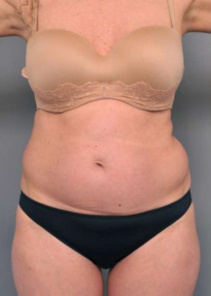 Tummy Tuck Before & After Patient #319