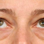 Eyelid Surgery Before & After Patient #1550