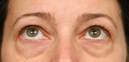 Eyelid Surgery Before & After Patient #1550