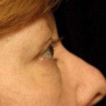 Eyelid Surgery Before & After Patient #1557