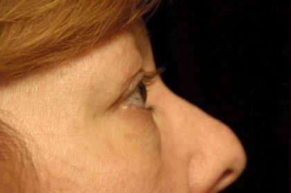 Eyelid Surgery Before & After Patient #1557