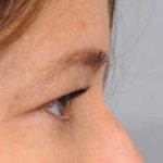 Eyelid Surgery Before & After Patient #1565