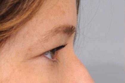 Eyelid Surgery Before & After Patient #1565